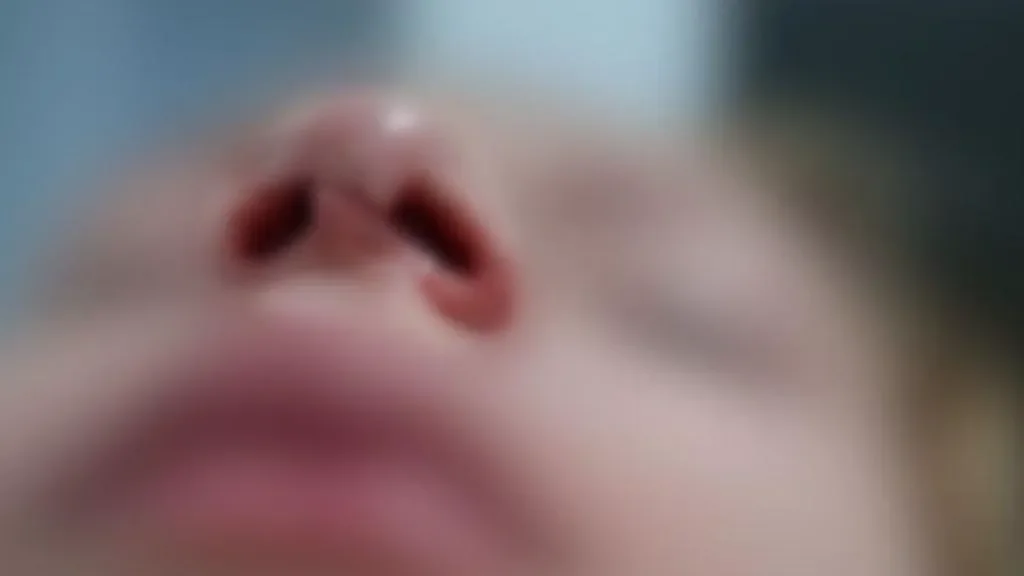Cerol atinge menina de 7 anos e provoca ferimento no rosto